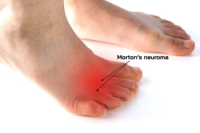 Morton’s Neuroma and Finding Relief
