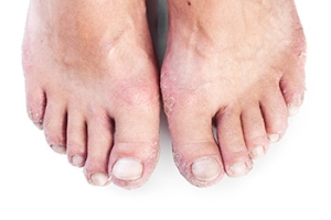Is It Foot Fungus or Psoriasis?