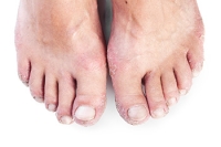 Is It Foot Fungus or Psoriasis?