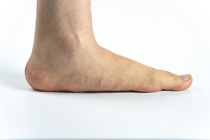 Overpronation From Flat Feet