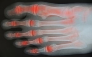 Assistive Devices for Foot or Ankle Arthritis