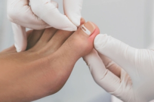 Ingrown Toenail Infections