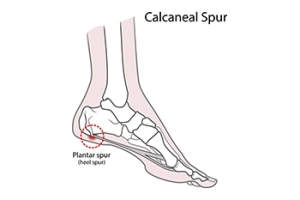 What Is a Heel Spur?