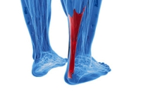 Achilles Tendon Ruptures in Sports Activities